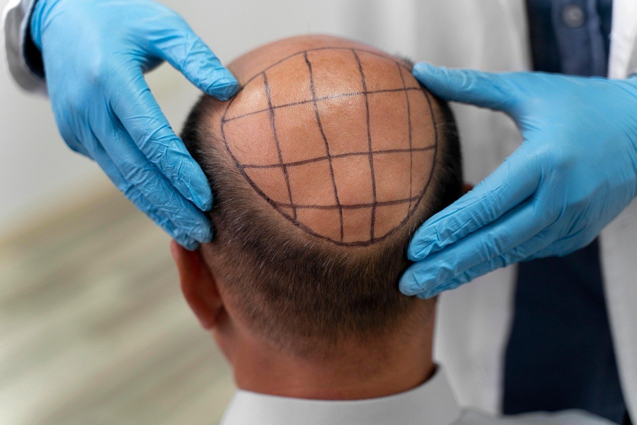 découvrez les causes, traitements et solutions efficaces pour la perte de cheveux afin de retrouver une chevelure saine et dense.